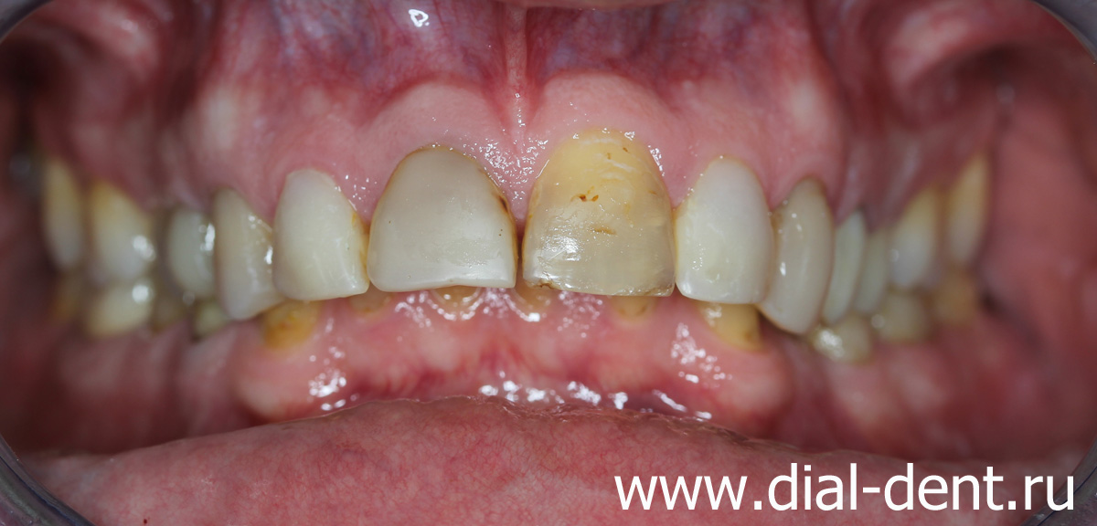 После лечения на брекетах передние зубы выпирают вперед